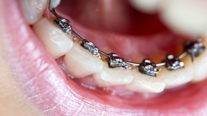 how do dentist put on braces